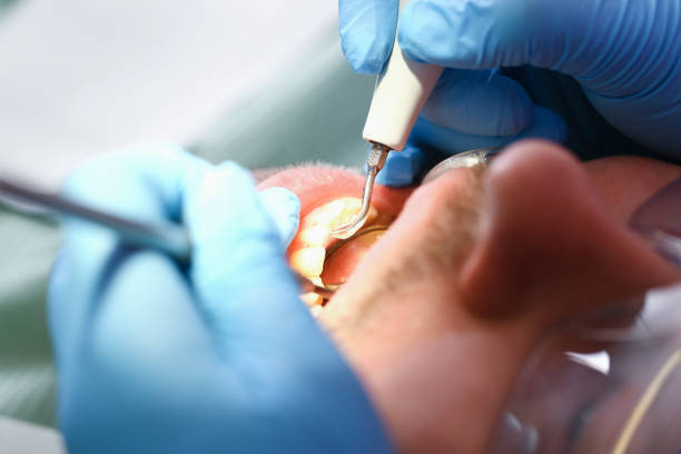 Best Emergency Root Canal Treatment in Carthage, MS