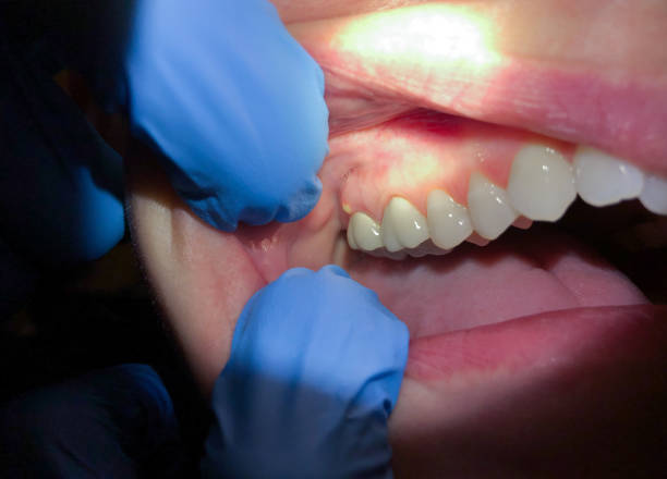 Best Emergency Gum Treatment in Carthage, MS